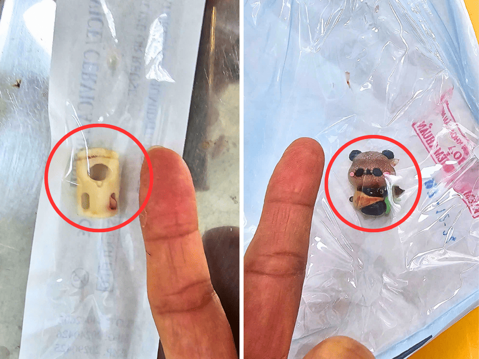 XỬ TRÍ THÀNH CÔNG CA MẮC DỊ VẬT TRONG ÂM ĐẠO GÂY VIÊM Ở BÉ GÁI 6 TUỔI